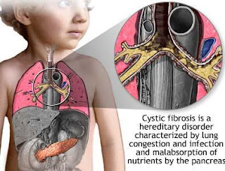 cystic fibrosis symptoms