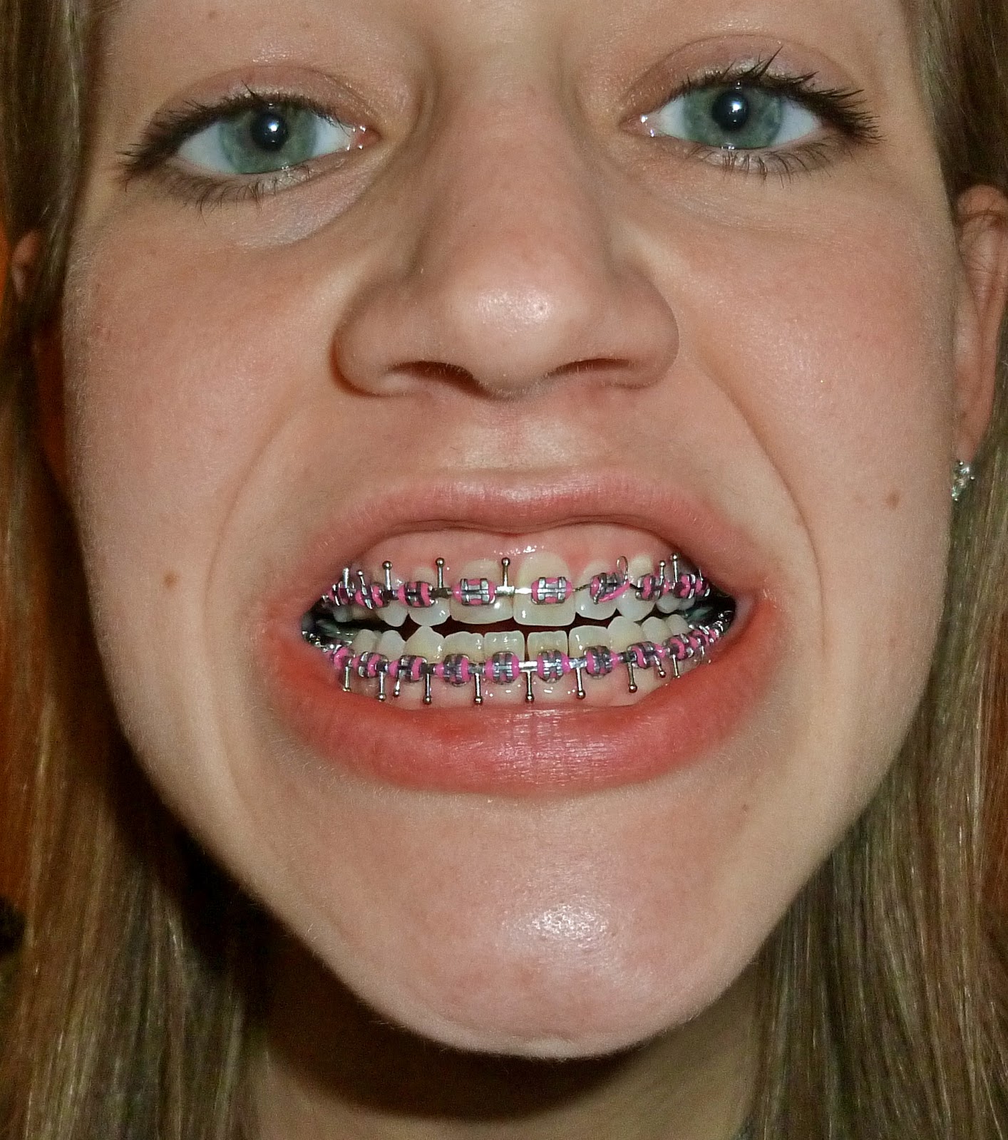 A dental student with an orthognathic problem check out my new GRILL