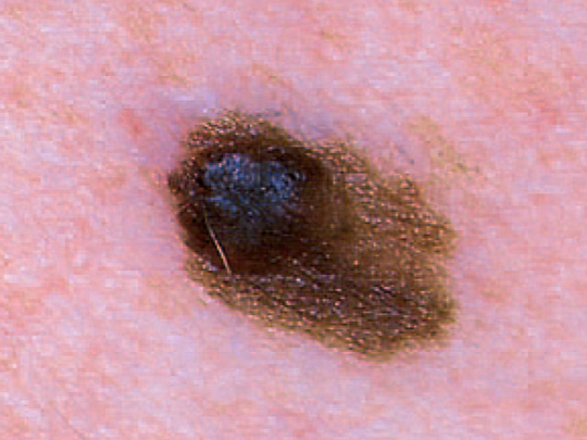 raised melanoma