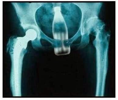 Image result for coke bottle x rays