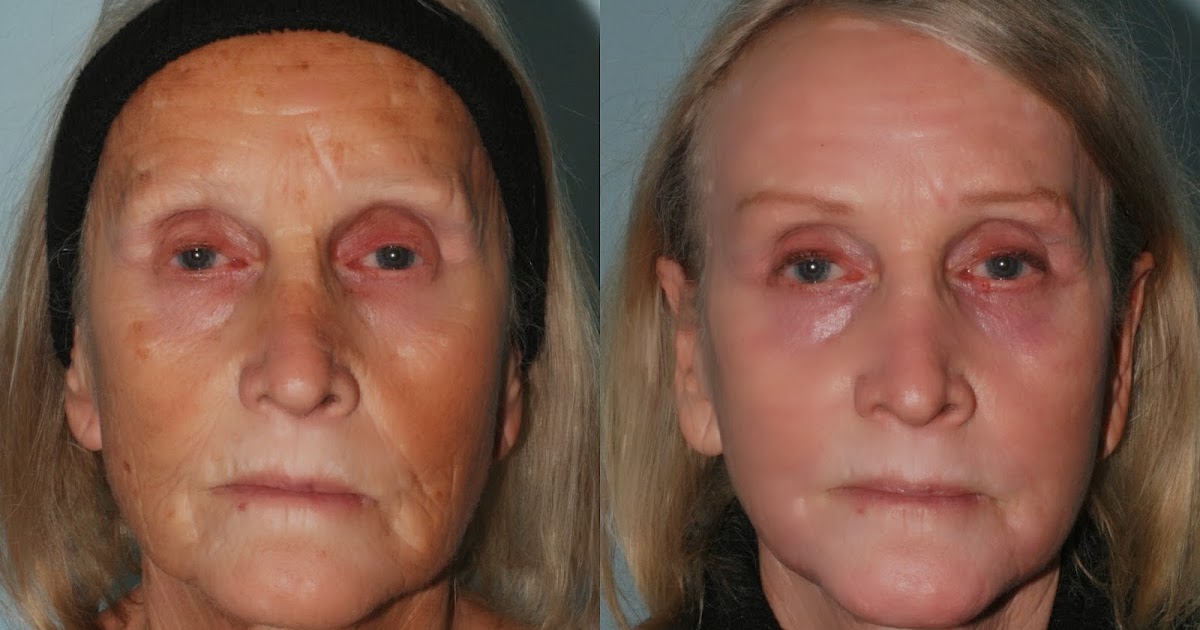 SKINALITY: Laser Wrinkle (Resurfacing) Treatment