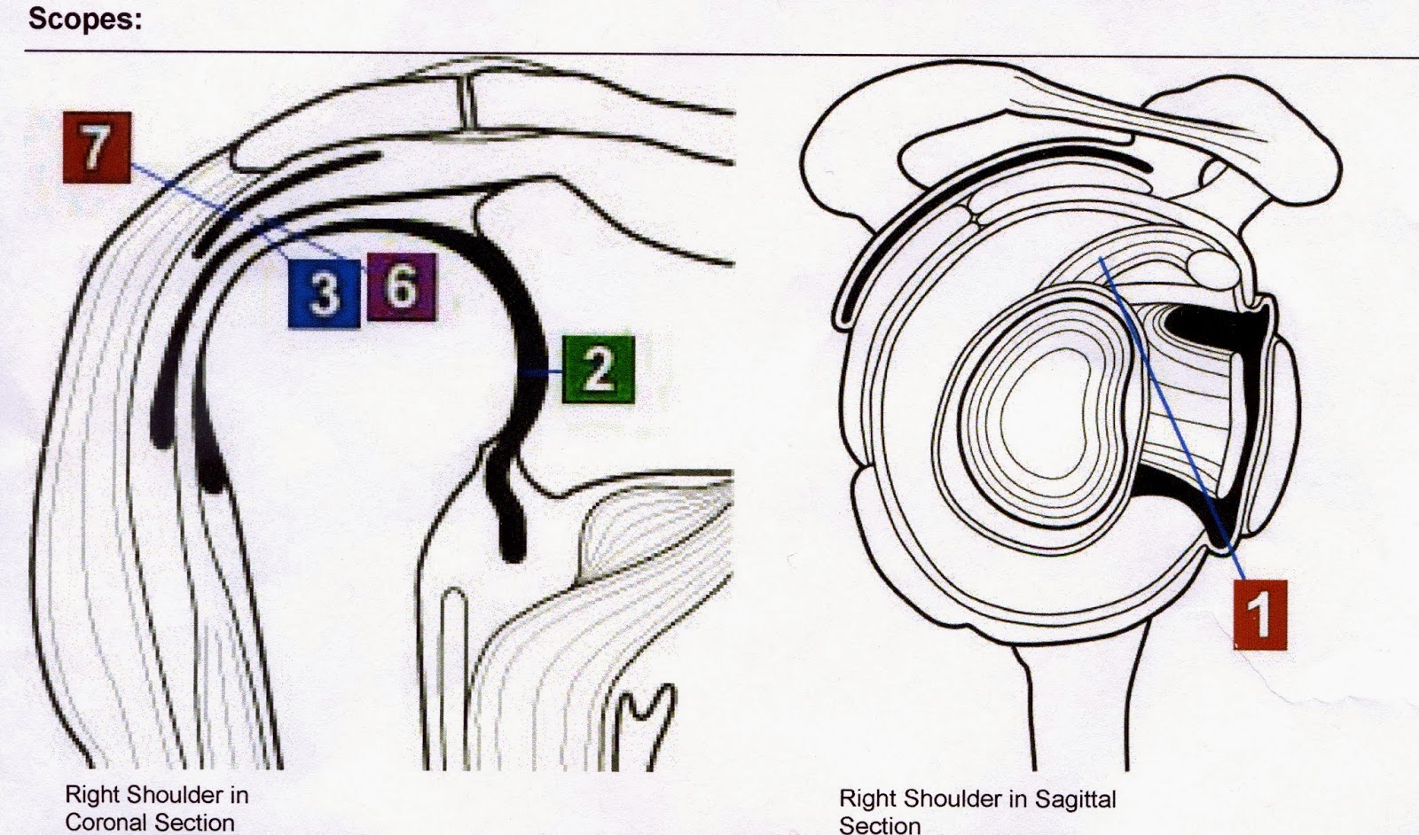 Miscellanium Variousica Surgery to Remove Calcific Tendinitis In Right