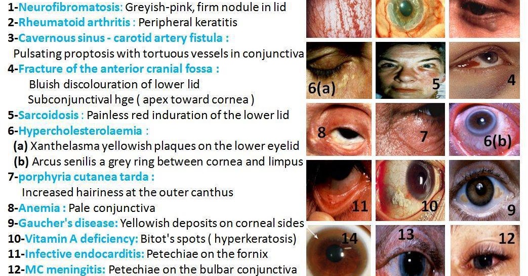 Helps Diagnosis... Some eye disorders with signs.. General Knowledge
