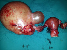 Right ovarian tumor