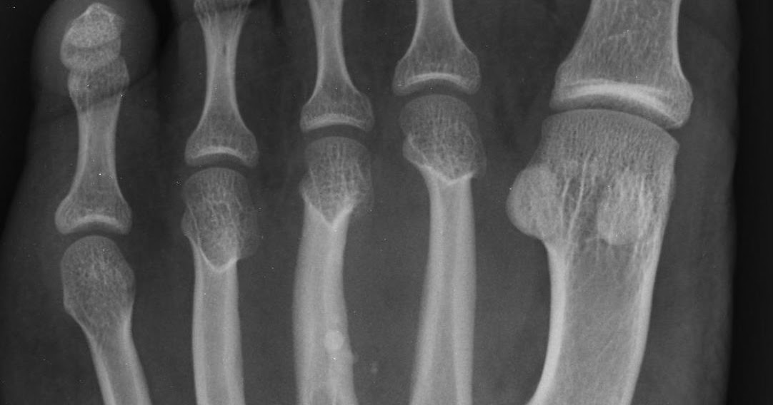 DETROIT RUNNER.... My experience at the foot doctor