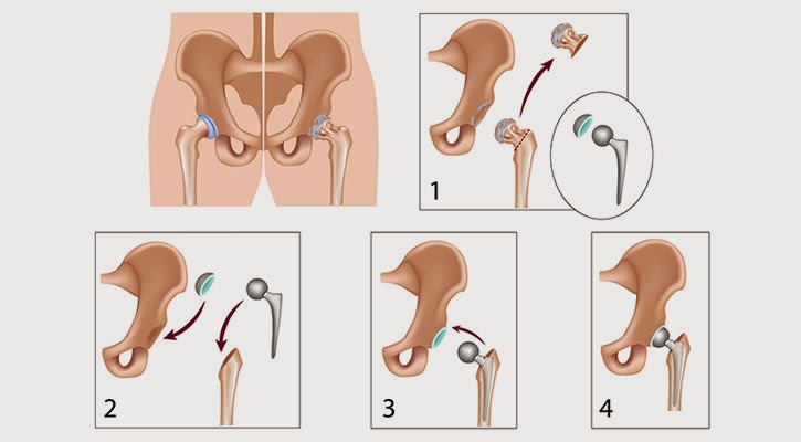 hip replacement