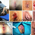Obat Ambeien Selain Superhoid di Mitra Farma thumbnail