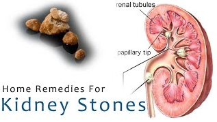 Stone in Stomach