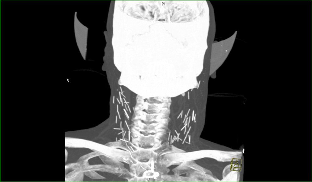 Deformutilation XRay Reveals Needles in the Neck