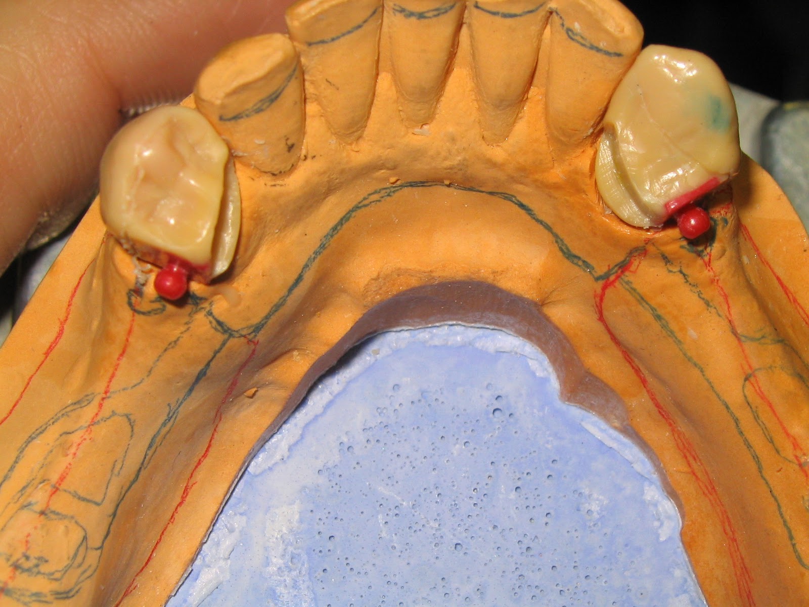 Boise Idaho Prosthodontics SemiPrecision attachment RPD 3 different