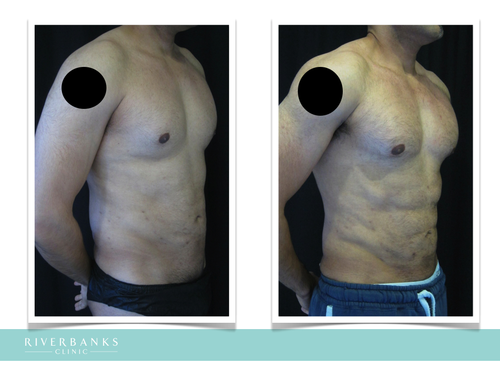 What Is Vaser Body Sculpting at Richard Butler blog