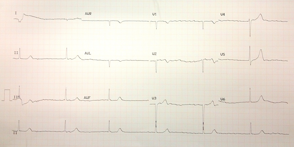 Atrial Fibrillation And Complete Heart Block vrogue.co