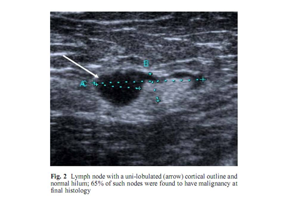 BÀI SOẠN VỀ SIÊU ÂM CHẨN ĐOÁN: STAGING BREAST CANCER by US-GUIDED