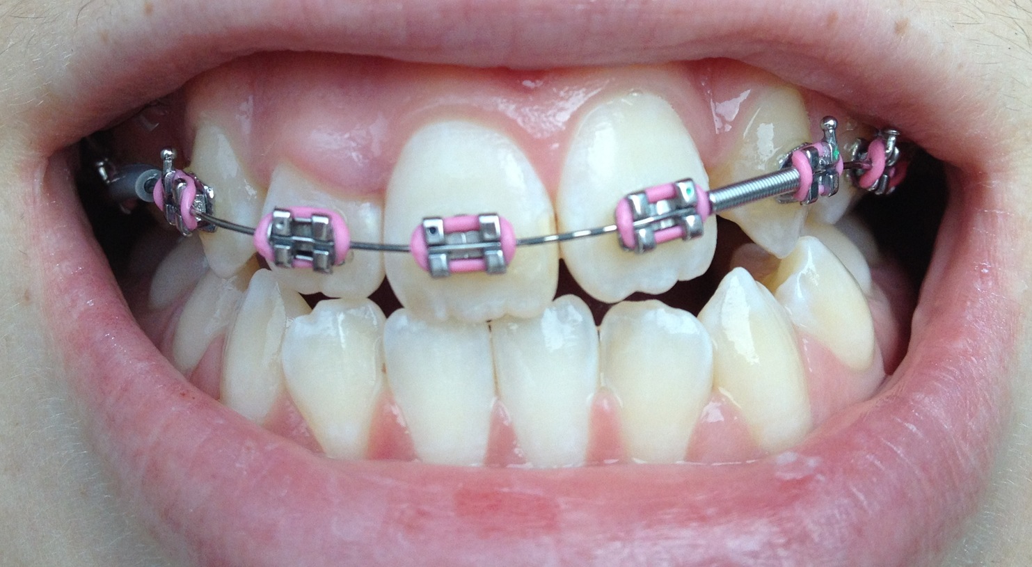 shifted teeth shifted teeth