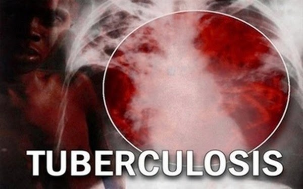 Tuberculosis Patient in Garments Industry