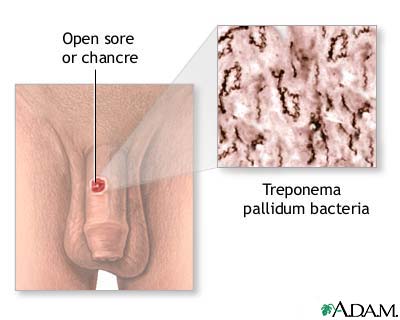 Mild Syphilis