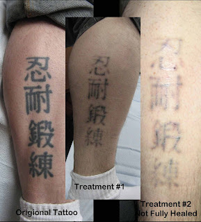 Tatto Removal Laser on The Arthouse Inc  Laser Tattoo Removal   Cynosure Affinity Qs