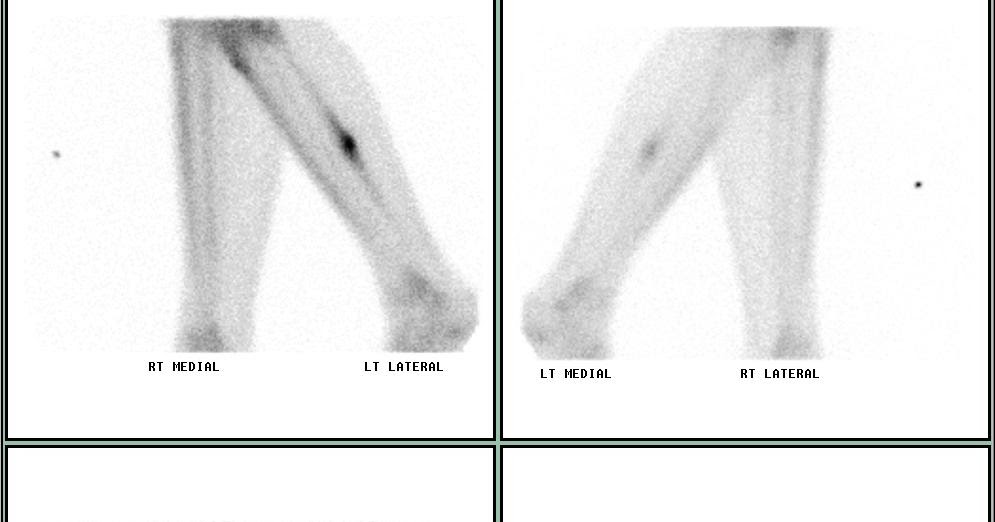 stress fracture shin workouts stress fracture shin workouts