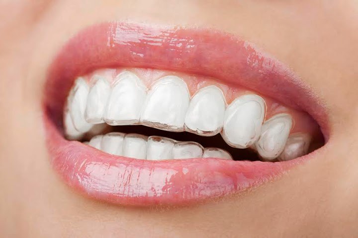 Consulta de Aprovação do Tratamento com Invisalign - Vs Ortodontia