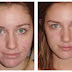 Microdermabrasion Before and After