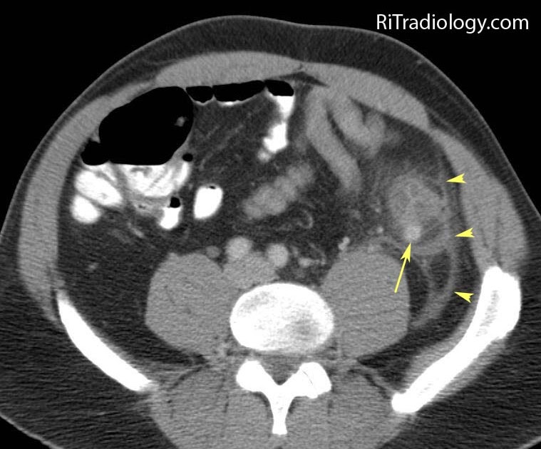 RiT radiology Acute Sigmoid Diverticulitis