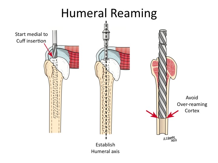 Shoulder Arthritis / Rotator Cuff Tears causes of shoulder pain A