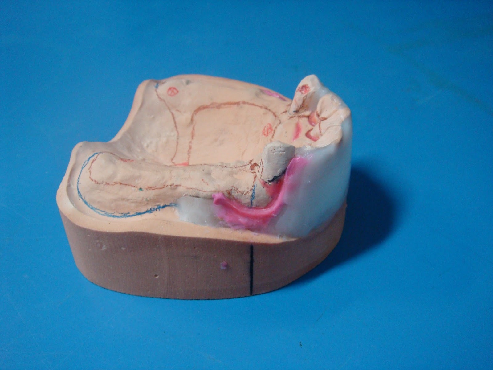 Step by step Guide for Understanding the Prosthodontics A step by step
