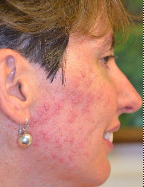 VIRTUAL GRAND ROUNDS IN DERMATOLOGY 2.0: Rosacea-Like ...
