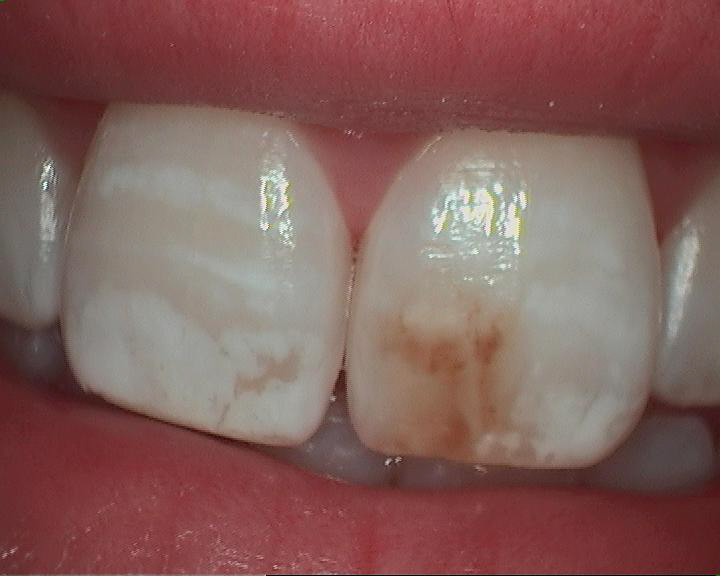 DrChetDMD Twelve Days To My Wedding! Enamel Microabrasion