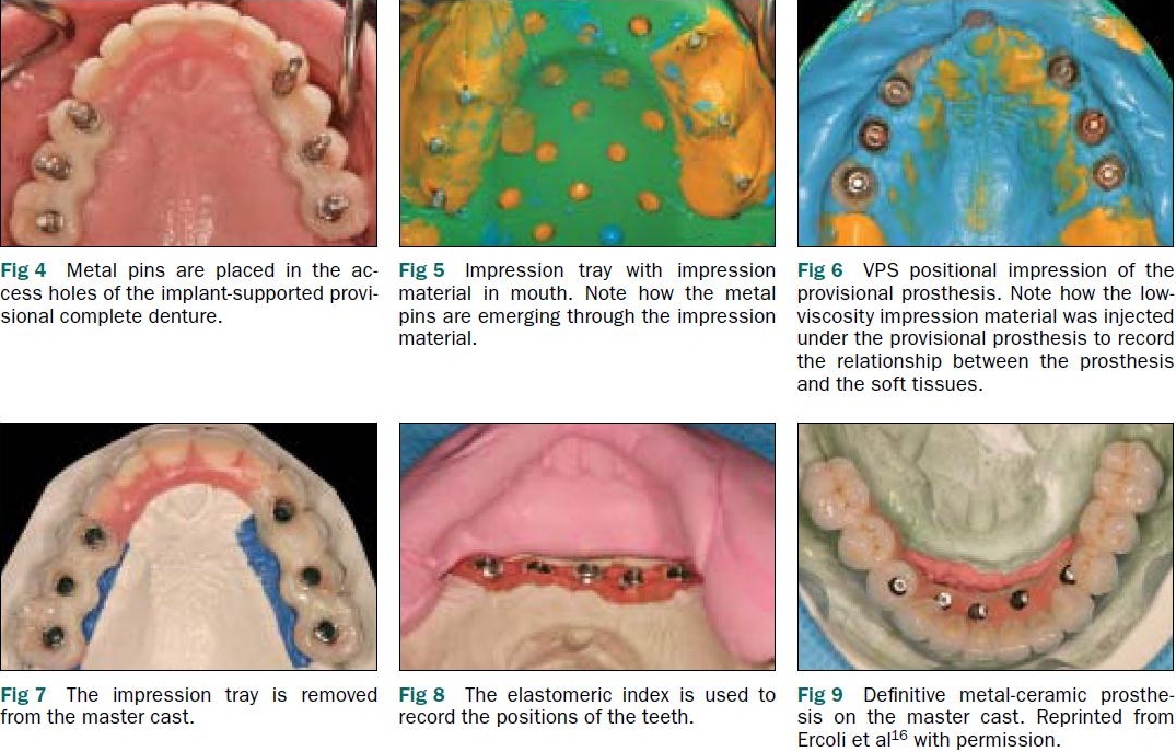 Implant Supported Prosthesis Final impression and verification of