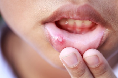 左上 唇 痙攣 唇にしびれを感じる６つの原因とは！ストレスに要注意！