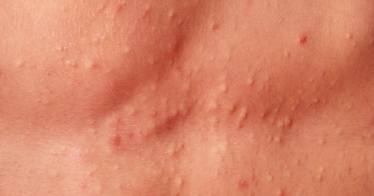 Virtual Grand Rounds In Dermatology 2 0 Vellus Hair Cysts