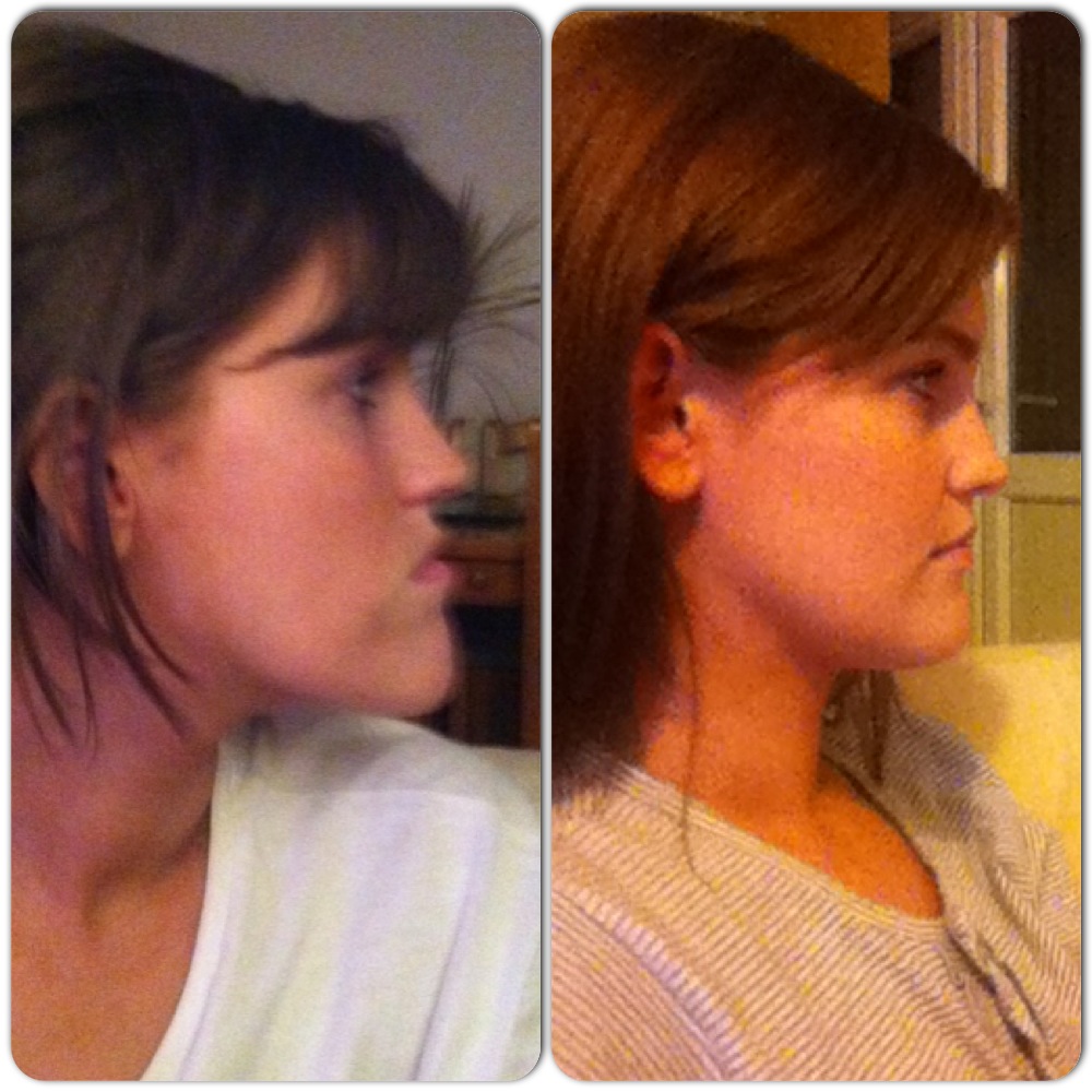 A Guide to Surviving Orthognathic Surgery Recent Press