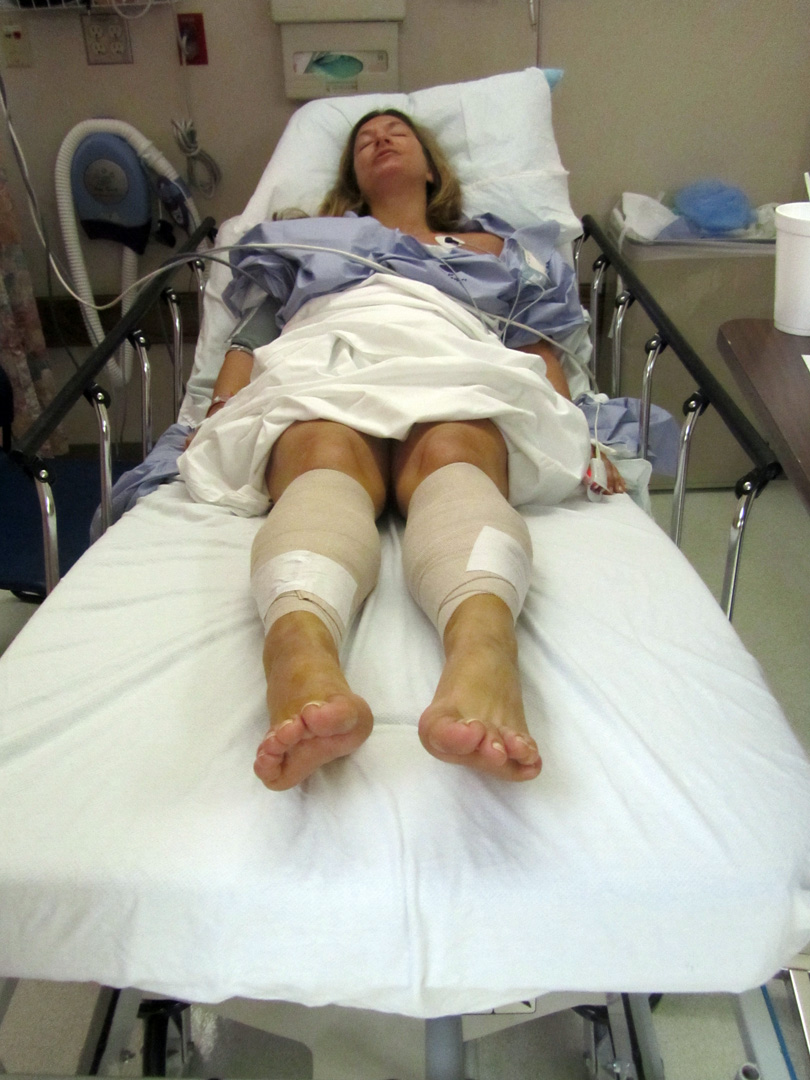 My Experience with Chronic Exertional Compartment Syndrome My Surgery