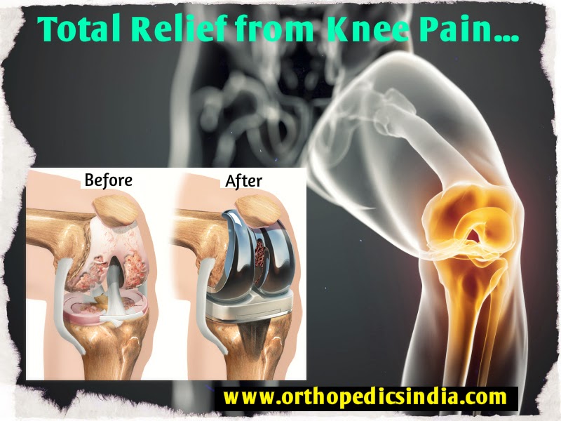 http://orthopedicsindia.com/knee-replacements.html