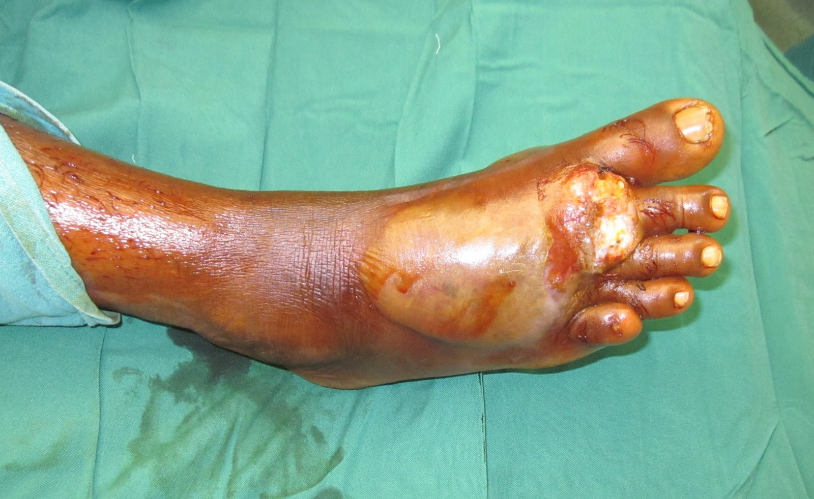 Wet Gangrene Toe