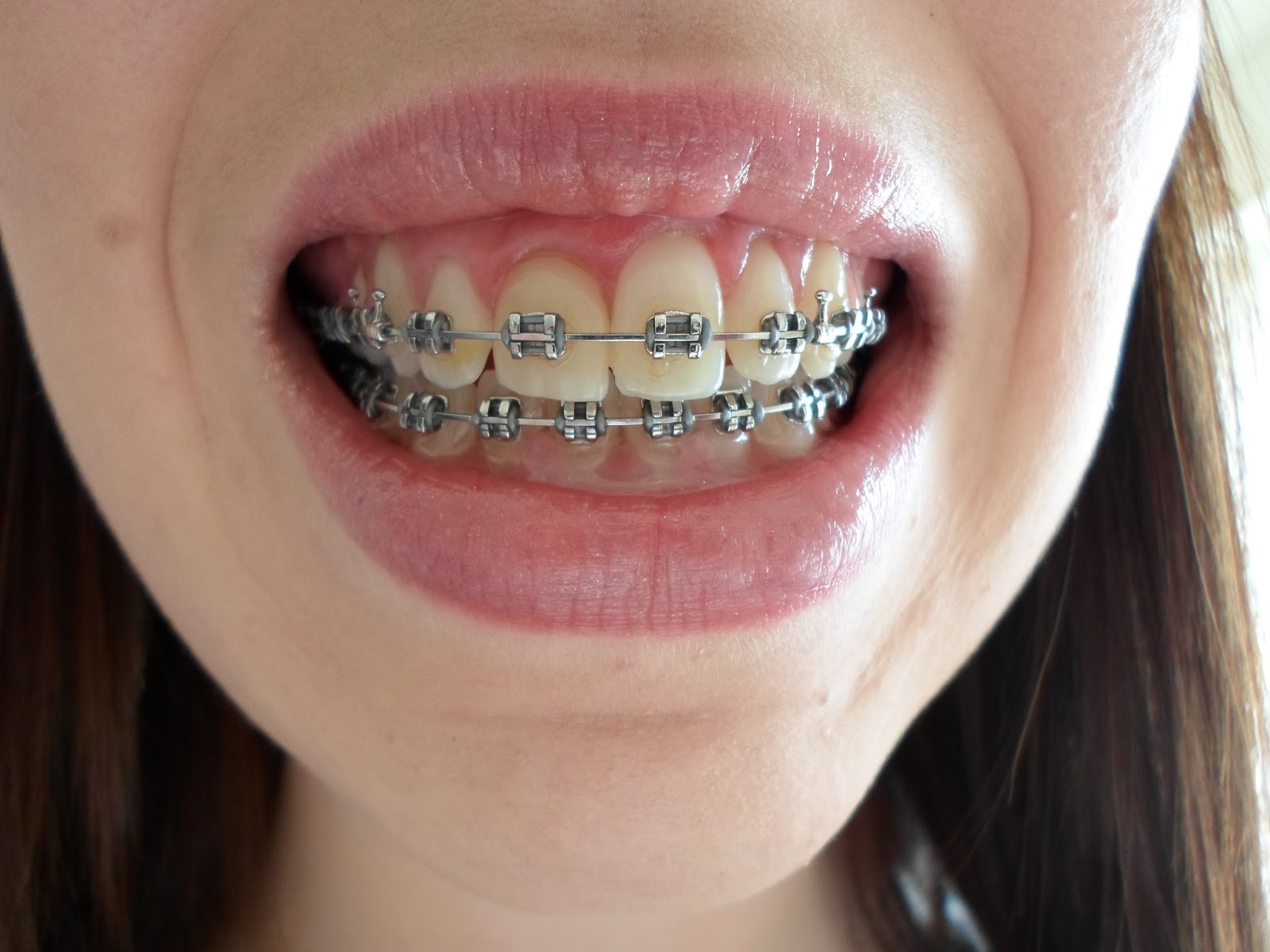 My jaw surgery and I.. Surgical Hooks On!