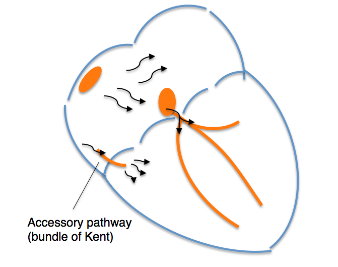 Sindrom WolffParkinsonWhite INA ECG