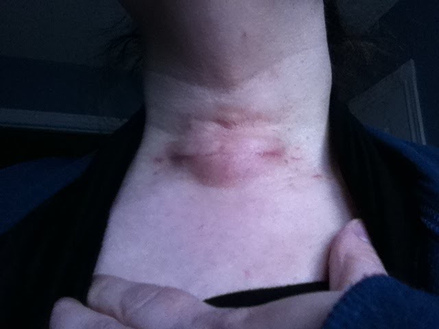 My Thyroidectomy: A Personal Account: 2 Weeks Post-Thyroidectomy