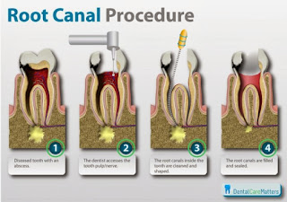 http://www.dentistinchennai.com/root-canal-treatment.php