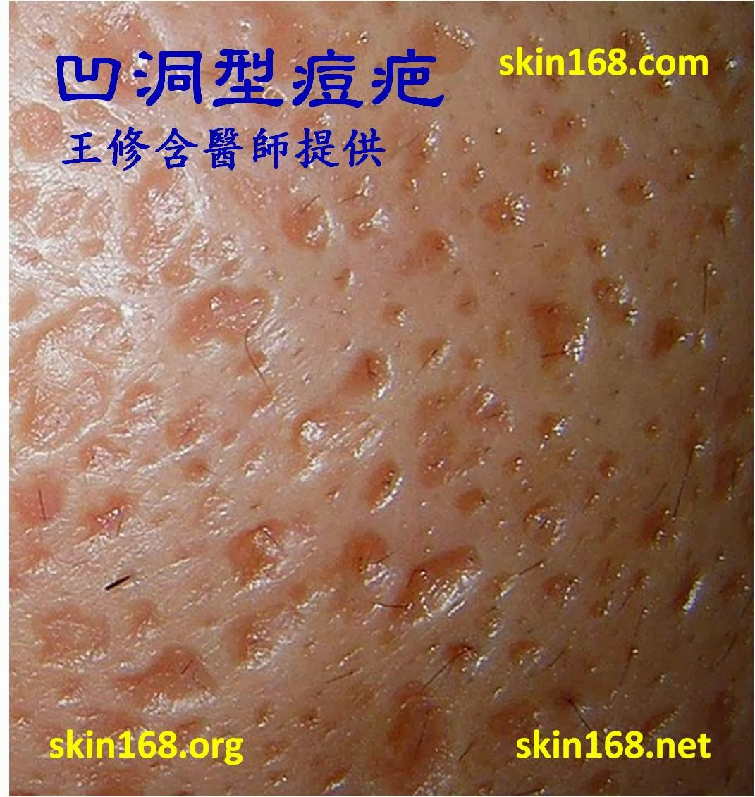 Acne Around Mouth Means Zyrtec