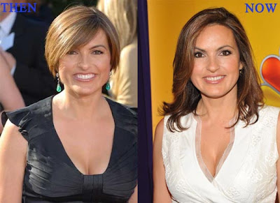 Mariska Hargitary Before & After Plastic Surgery |Alia Bhatt