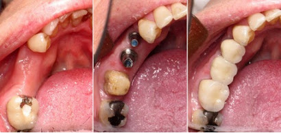 Steps in Implant Procedure