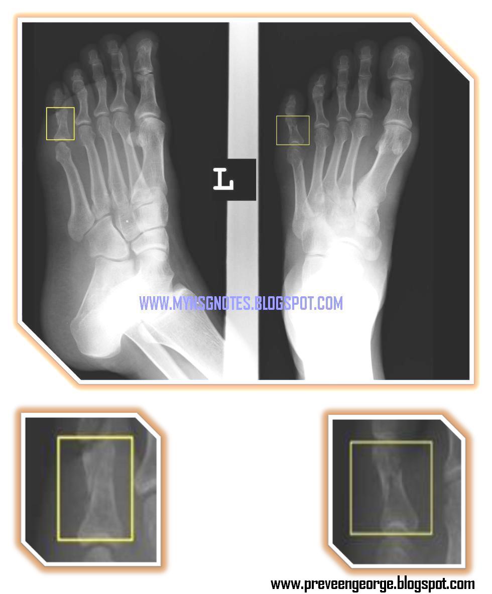 My Nurses Notes PROXIMAL PHALANX OF LITTLE TOE