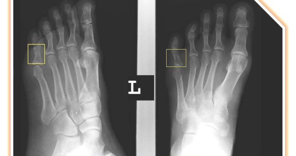 My Nurses Notes PROXIMAL PHALANX OF LITTLE TOE
