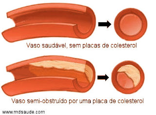 Placa de colesterol na artéria