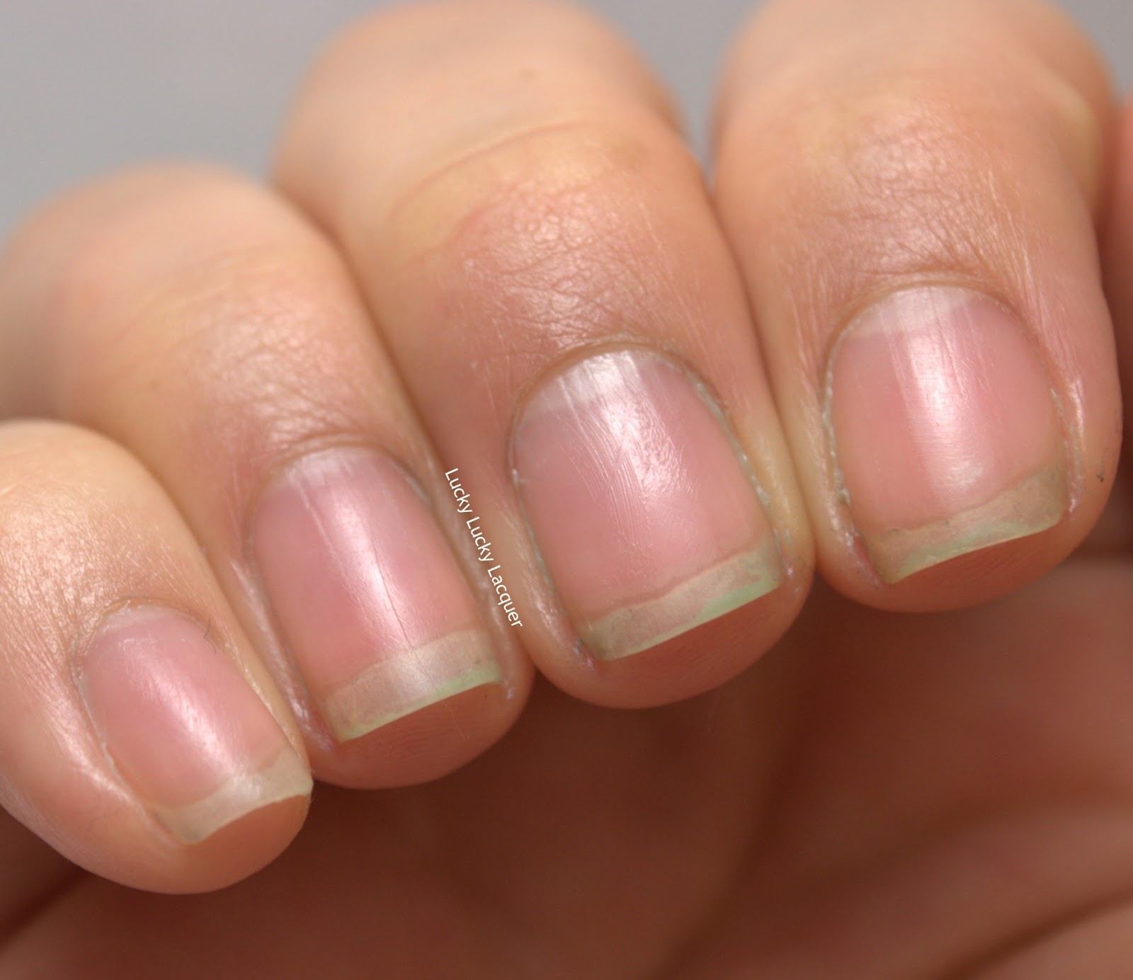 Cuticle overgrowth blasthac