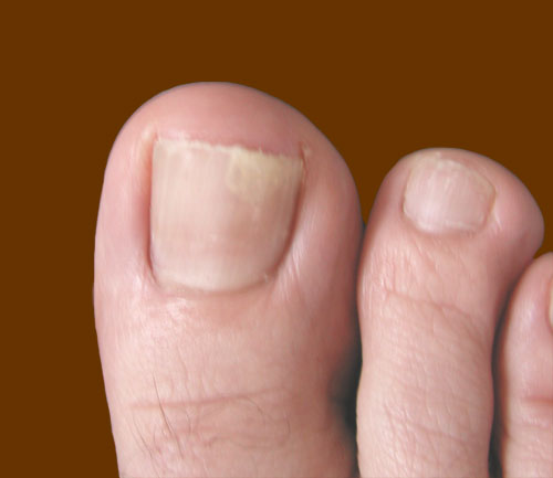 My Simple Notebook: What causes nail fungus?