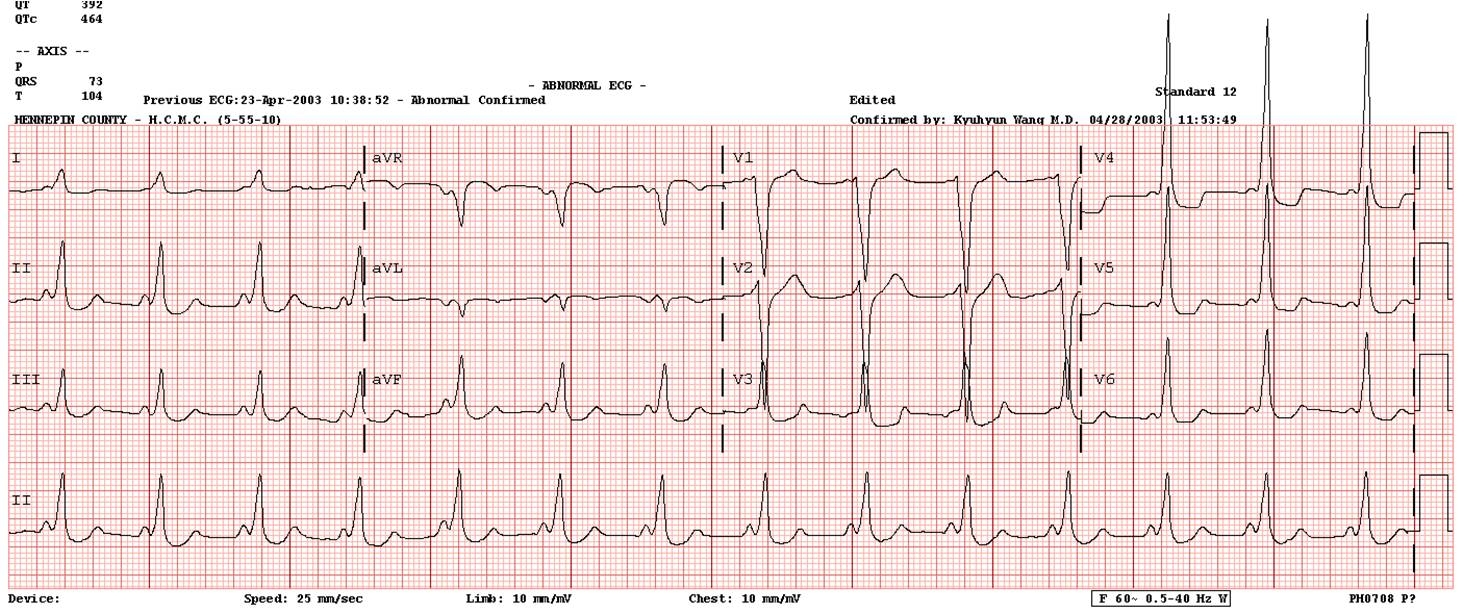 V Tach Ecg