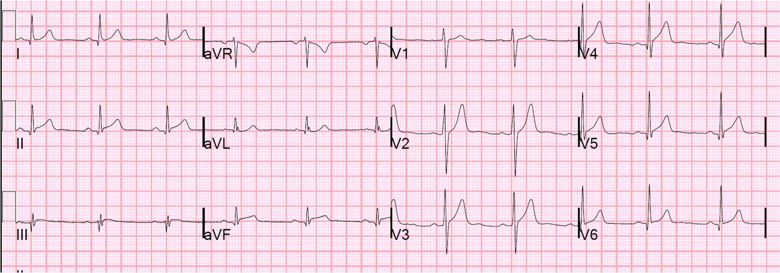 Dr. Smith's ECG Blog Is this ACS? Look at the previous ECG!!